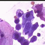 Κυτταρολογικός ελεγχος έρπητος τραχήλου της μητρας . Παρακολούθηση περιστατικού επί 15ετία. Μέρος 3. Kυτταρολογικά 1997 - 2004 .